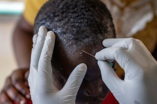 La variole du singe ou mpox est une maladie virale provoquant fièvre, douleurs musculaires et lésions cutanées (archives). KEYSTONE/EPA/MOISE KASEREKA